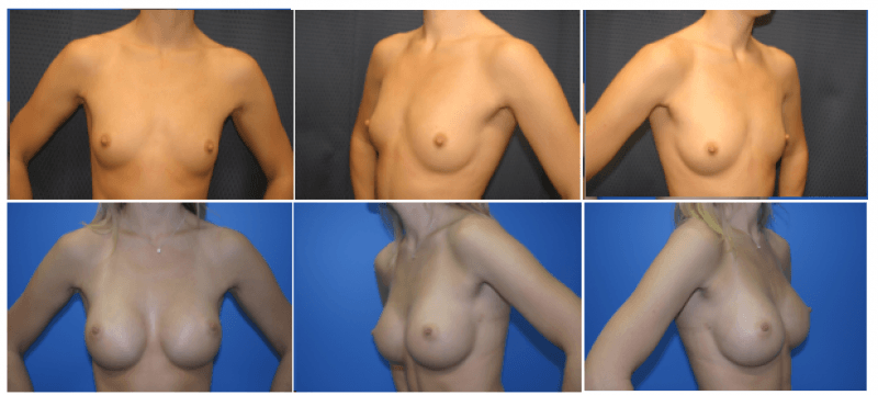 breast augmentation before and after pictures