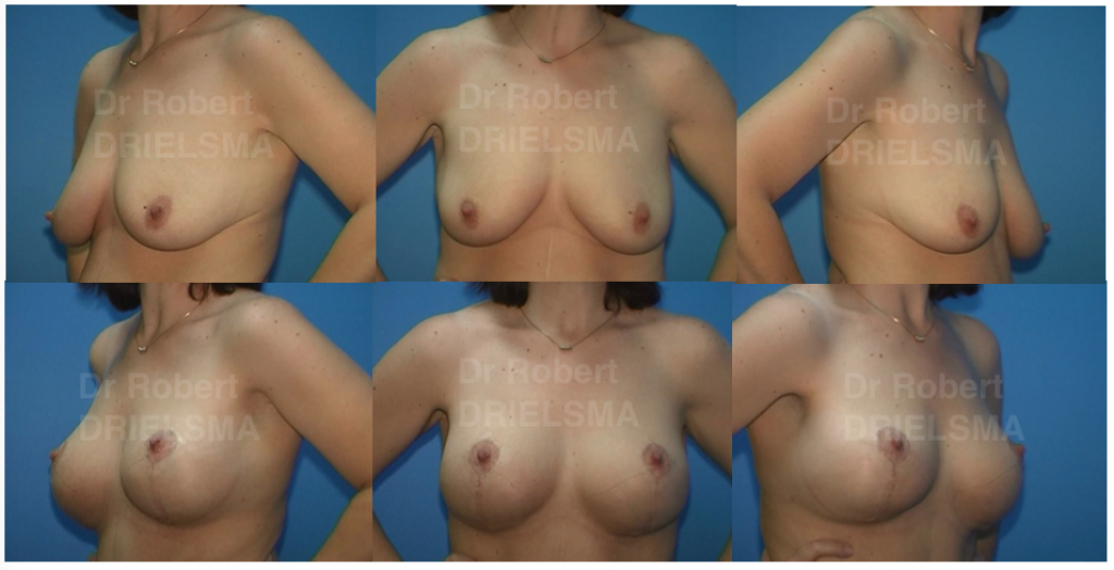 Leading Breast Lift with Implants Surgery in Sydney