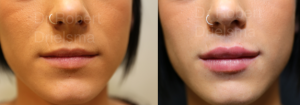 Lip Augmentation