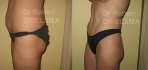 Tummy Tuck