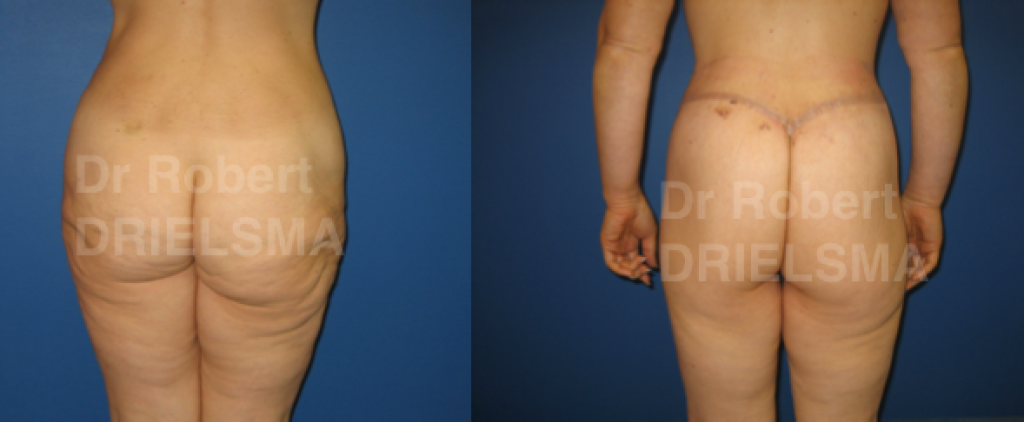 Body Lift Sydney Before and After