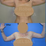 Arm Lift before and after