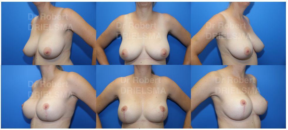 breast reduction