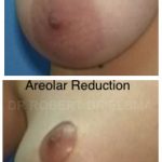 Nipple Surgery Before and After
