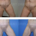 Inner Thigh Lift Before and After Photos