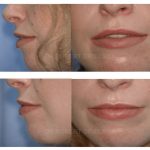Lip Augmentation Before & After