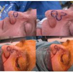 Nose Skin Cancer Before & After