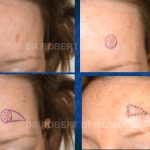 Forehead Skin Cancer Before & After