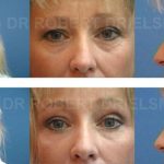 Eye Lift Surgery Before and After