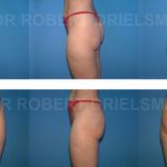Liposuction/Liposculpture Before & After