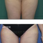 Inner Thigh Lift Before and After Photos