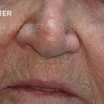 Nose Skin Cancer After