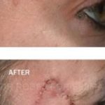 Eye Skin Cancer Before & After