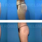 Liposuction/Liposculpture Before & After