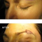 Eyebrow Skin Cancer Before & After