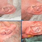 Ear Skin Cancer Before & After