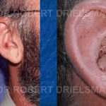 Ear Skin Cancer Before & After