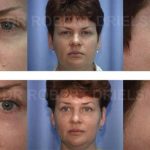 Eye Lift Surgery Before and After