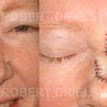 Nose Bridge Skin Cancer Before & After