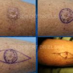 Skin Cancer Before & After