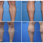 Calf Implants Before & After