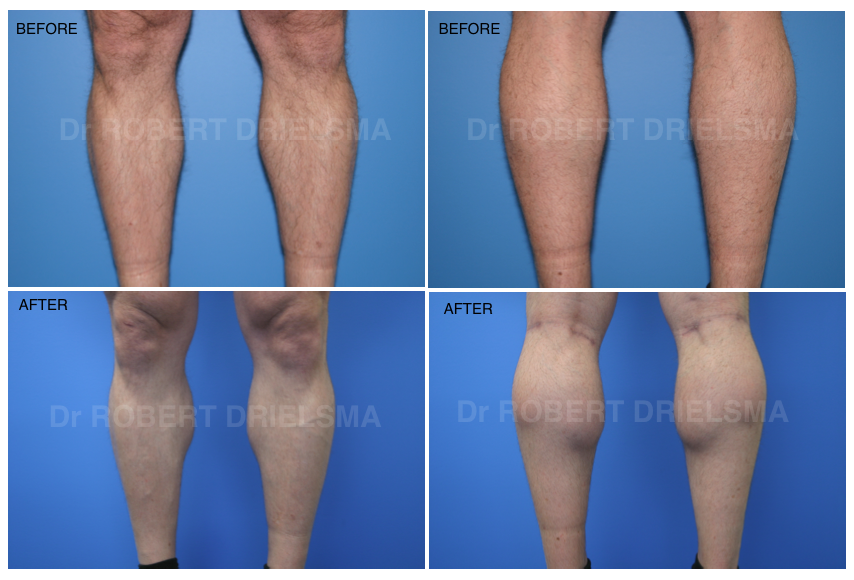 Calf Implants Before & After