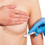 types of breast lift techniques