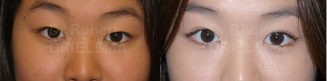 Asian Eyelift SurgeryBlepharoplasty Dr. Robert Drielsma Sydney