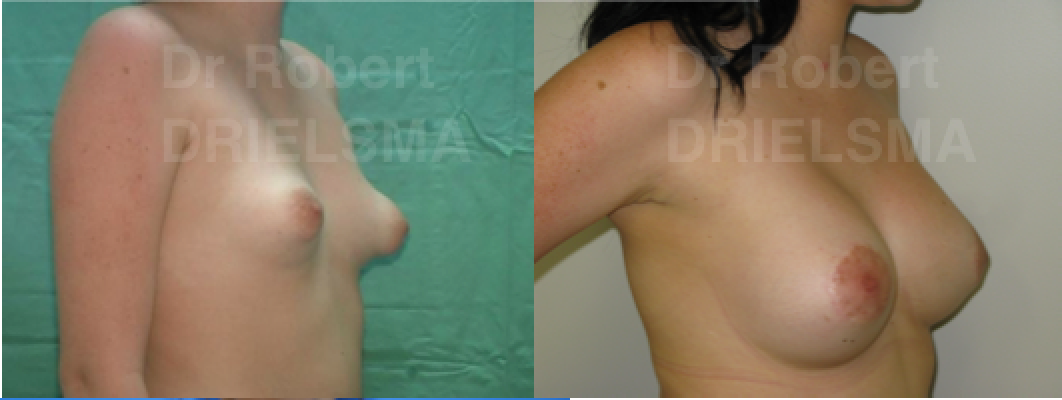 Tuberous Breast Deformity Correction Before and After