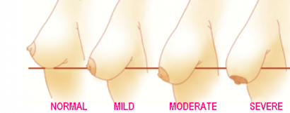 sagging breasts grade