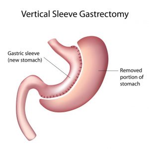 bariatric surgery