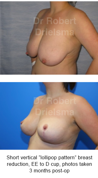 breast reduction