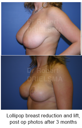 breast reduction