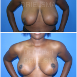Lollipop-Breast-Reduction