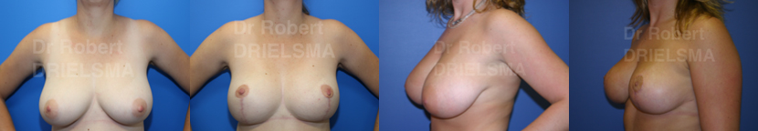 Breast Reduction Sydney Before and After