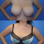 Lollipop Breast-Reduction