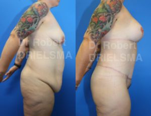 Body Lift Sydney Before and After