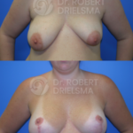 Breast Reduction/Lift with implants