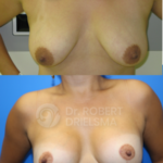 Lollipop Breast-Lift with Implants