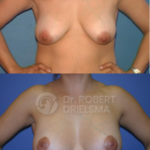 Lollipop Breast lift with implants