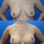 Lollipop Breast Lift with implants