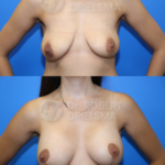 Lollipop Breast-Lift with implants