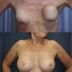 Revision breast surgery