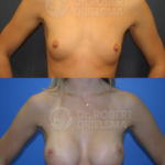 Breast-Augmentation