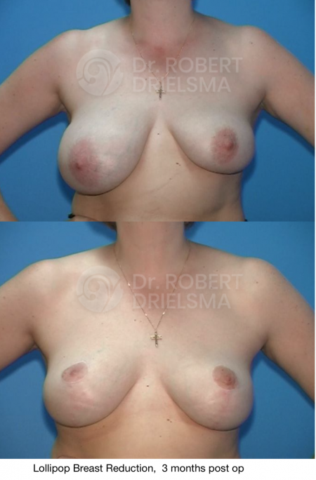 Myths About Breast Reduction Surgery - scarring example from Dr Drielsma
