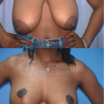 Breast-Reduction-Lollipop