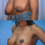 Breast-Reduction-Lollipop