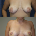 Inverted Nipple correction