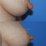 Nipple reduction