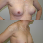 Revision breast surgery